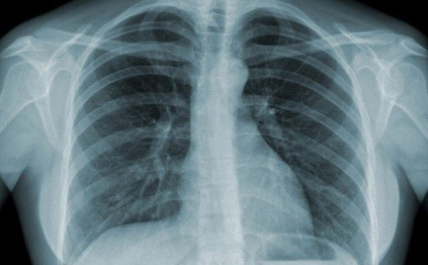 Chụp X-quang ngực giúp xác định chẩn đoán tràn dịch màng phổi